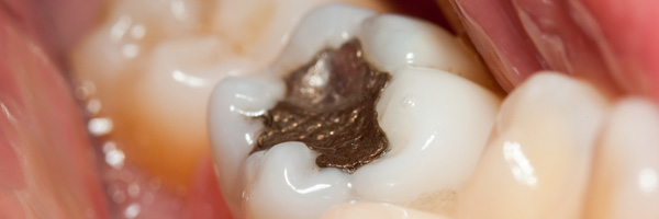 John Pierse Dental - Fillings Amalgam