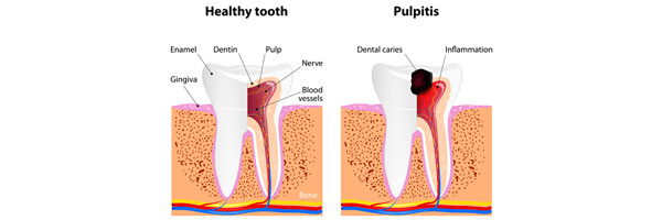 John Pierse Dental - Root Canal Treatment
